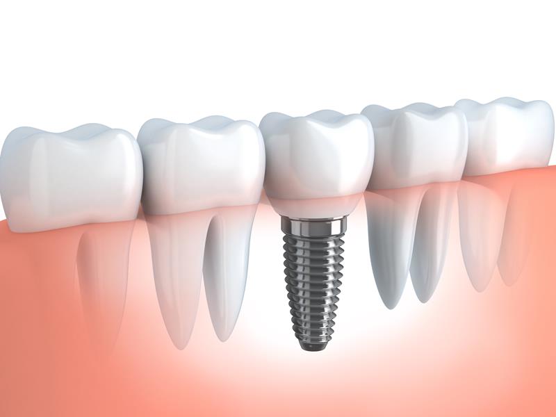 Dental Implants Edwardsville, IL