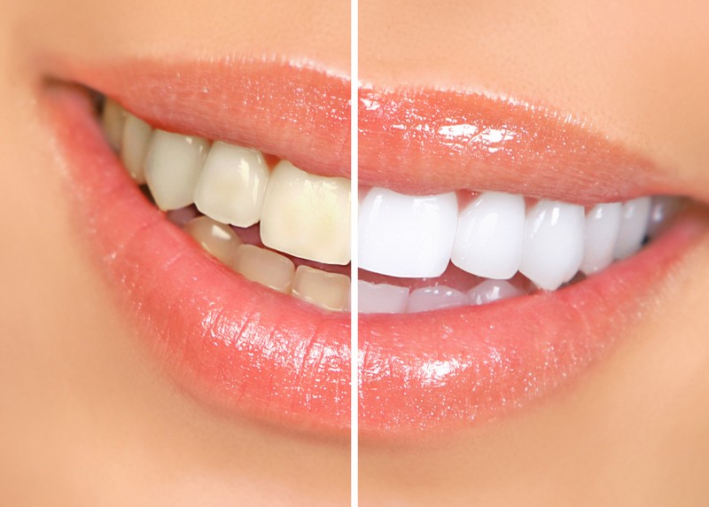 Teeth Whitening Edwardsville, IL